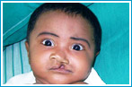 Before Cleft Lip Surgery