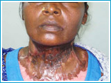 After Post Burn Contracture Neck
