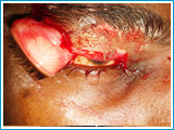 Before Injury Eyelid