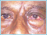 After Loss of Eyelid