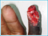 Skin loss on finger tip