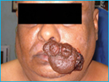 Before Tumor in Upper lip