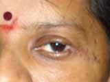 After Tumor Eyelids Surgery